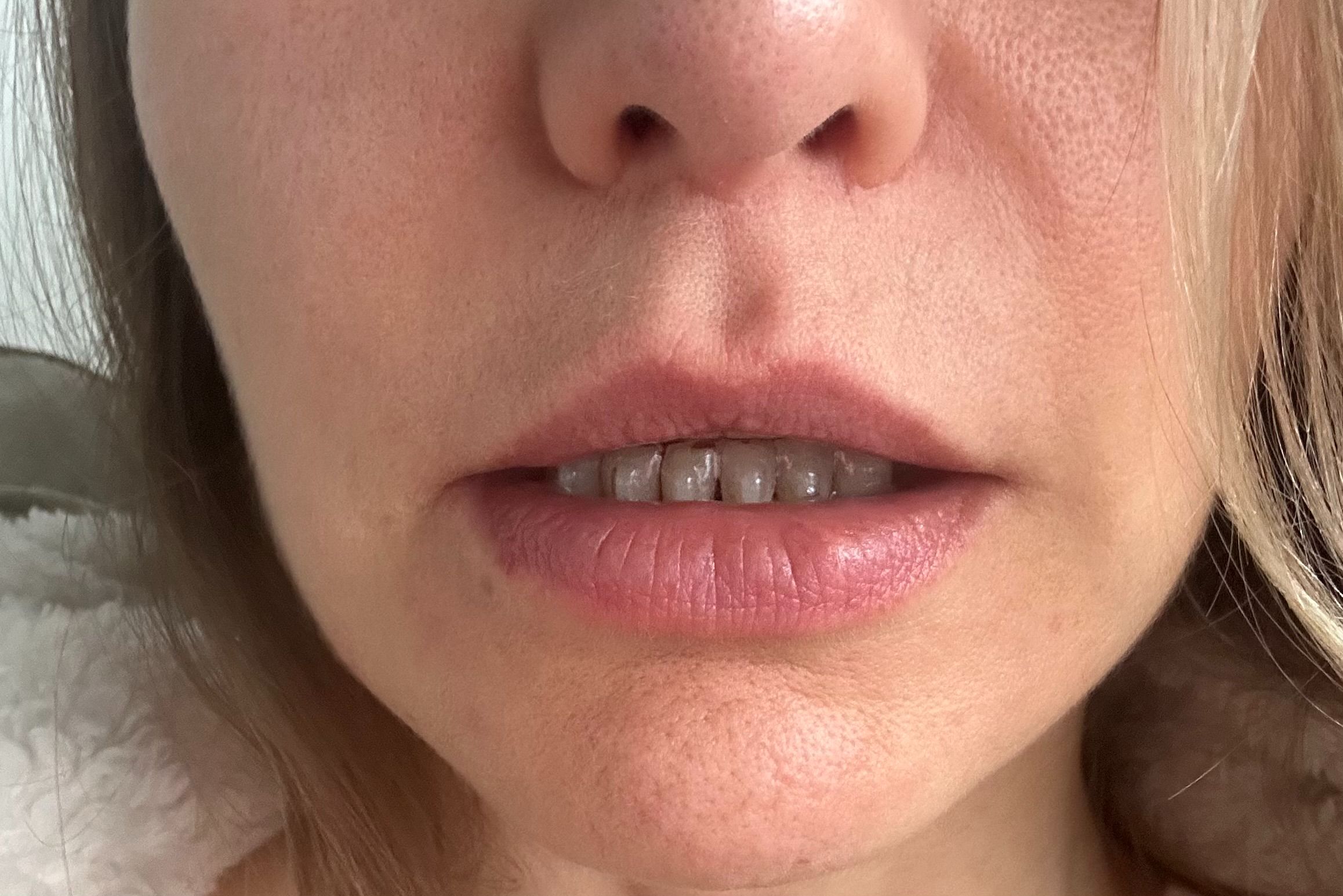 lip-lift-dr _mascaro.jpeg